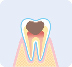虫歯の進行段階